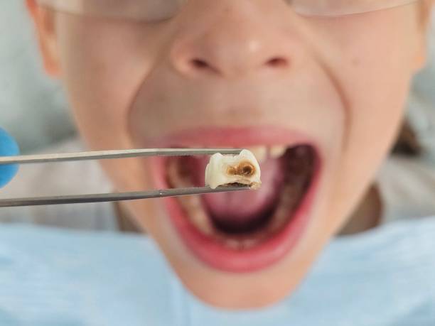 Best Emergency Treatment for Dental Infections or Abscesses in Dublin, VA